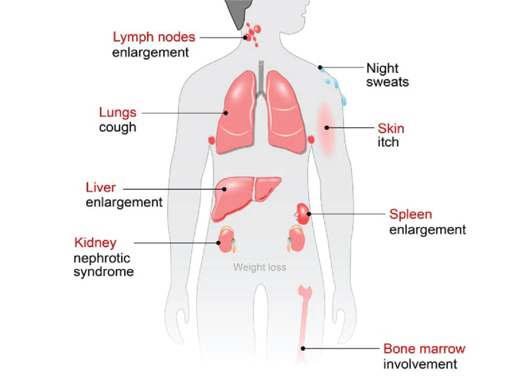 Lymphoma Cancer Treatment Lucknow Rudhir Arogya